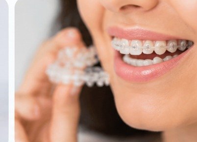 Orthodontic braces treatment
