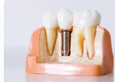 Dental implant model