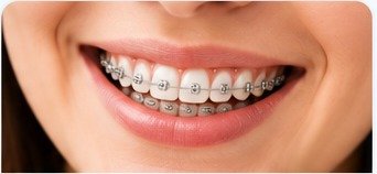 Dental braces and aligners