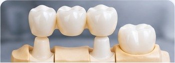 Dental crowns and bridges