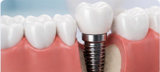 Dental implant treatment