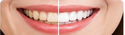 Smile makeover before and after
