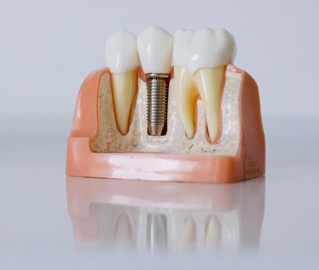 Dental implant