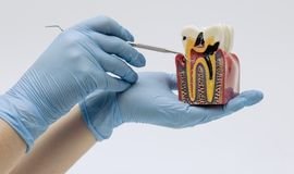 Root Canal Treatment