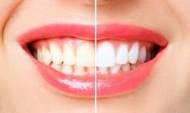 Teeth Whitening